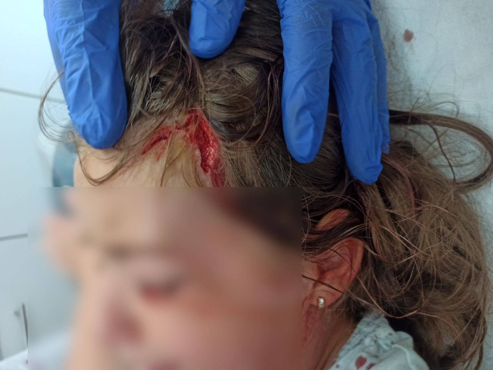 Шок обрт у Пријепољу, власник пит була који је напао дете негира да је животиња његова и каже да је пас луталица: Седмогодишња девојчица отпуштена из болнице, али и даље има трауме (ФОТО)